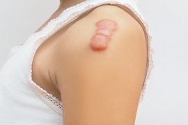 keloid scar of skin shoulder kid girl case of tissue forms over the wound to repair and larger than the original and treatment of laser to reduce size.