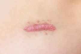 Close up of cyanotic keloid scar caused by surgery and suturing, skin imperfections or defects. Hypertrophic Scar on skin, dermatology and cosmetology concept.