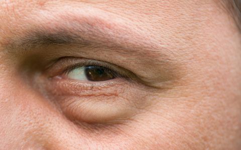 Eyesore, inflammation or bag swelling under eye. Medical problem like conjunctivitis