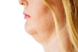 Woman before and after chin fat correction procedure