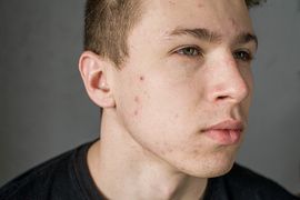 Young man struggling with acne on his face caring for his skin pushes acne