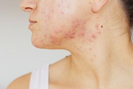 Acne on the face of young women. Improper therapy has led to a severe form of chronic inflammation face.-Image