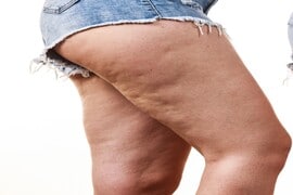 Comparison of female legs thighs with and without cellulite. Skin problem, body care, overweight and dieting concept.