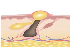 Medical vector illustration of different types of acne on human skin. Appearance of pimples in hair follicle.