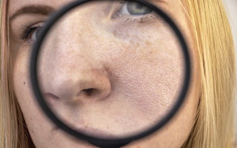 Expanded pores, black spots, acne, rosacea close-up on the nose. A woman is being examined by a doctor. Dermatologist examines the skin through a magnifier, a magnifying glass
