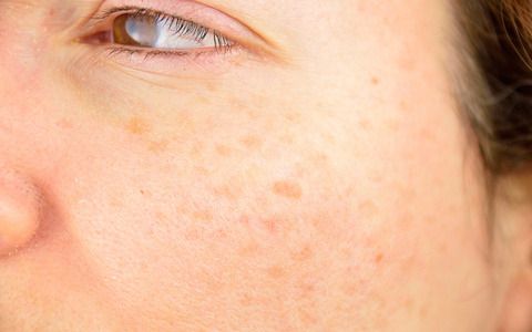 closeup of a woman cheek with liver spot causes by the large exposition sun