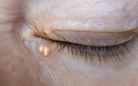 Close up of woman eyes with Xanthelasma on the eyelids. Hypercholesterolemia, high cholesterol